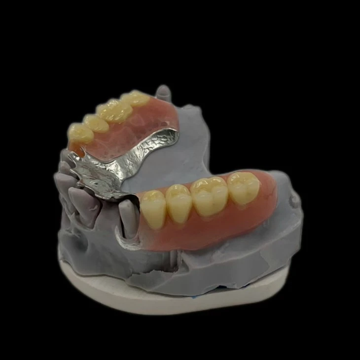 Cast Metal Framework Denture With Clear Clasp