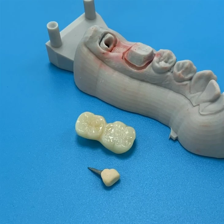 Full Contour Zirconia Bridge With Metal Core