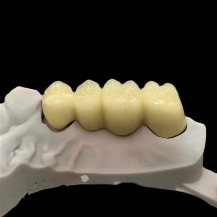 Metal Ceramic Posterior Bridge