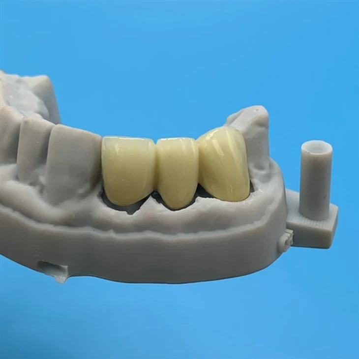 Non‑Precious PFM Bridge