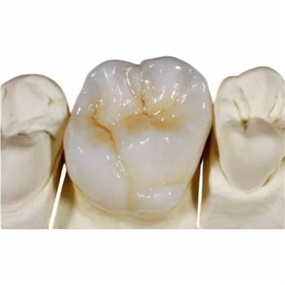 All Ceramic IPS Emax Crown