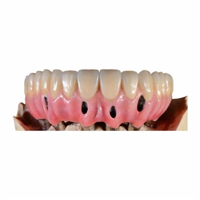 All-on-4 Full Arch Implant Malo Hybrid Bridge