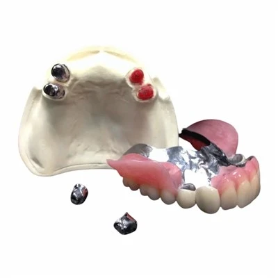 Ball Precision Attachment with RPD Metal Framework