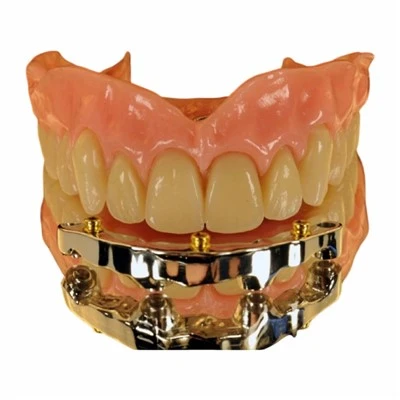 Bar Clip Precision Attachment Overdenture