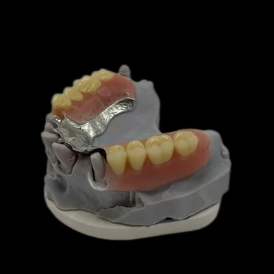 Cast Metal Framework Denture With Clear Clasp