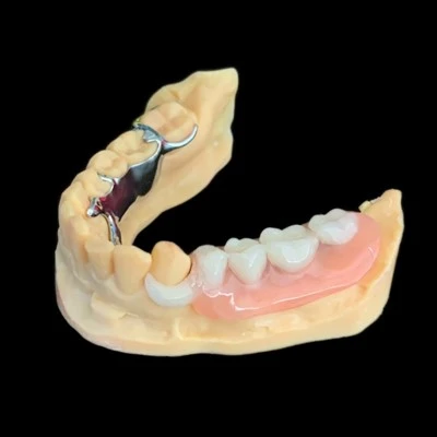 Metal Framework Denture With Tooth Colored Clasp