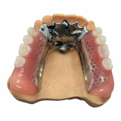 Cast Metal Framework with Lingual Plate