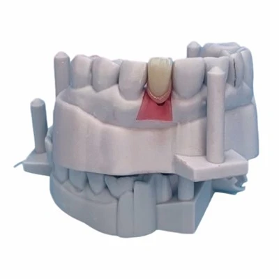 Cement-Retained Implant Cocr PFM Crown