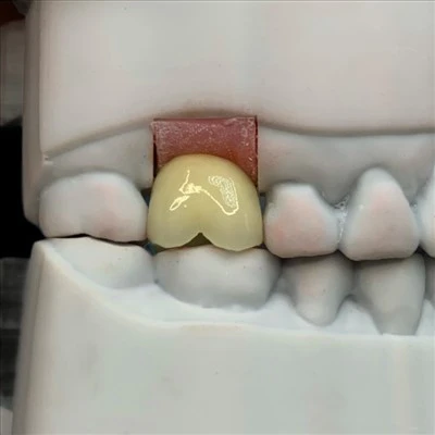 Cement-Retained Implant PFM Crown
