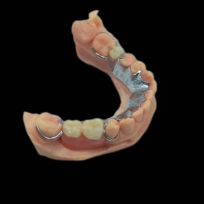 CoCr Metal Framework With Acrylic Denture