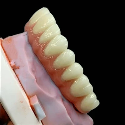 CoCr PFM Bridge With Gingival Porcelain