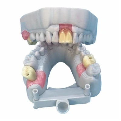 Dental Implant Zirconia Bridge