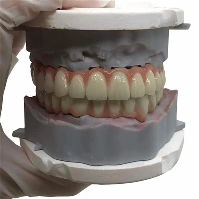 Dental PFM Bridge with Gingival Porcelain