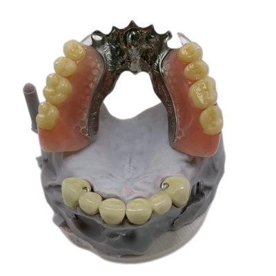 Fixed PFM Bridge Combined With Removable Partial Metal Framework Denture