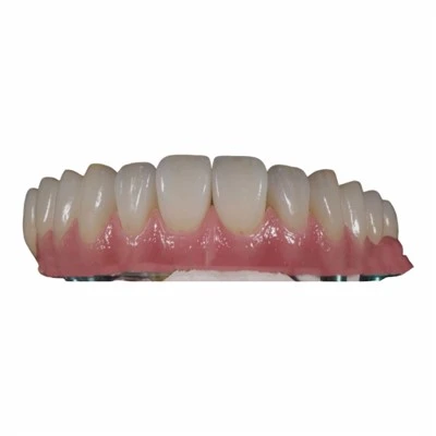 Full Arch Screw Retained Implant Malo Bridge