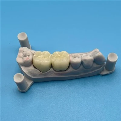 Full Contour Zirconia Crown