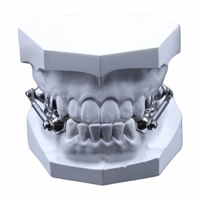 Herbst Orthodontic Appliance