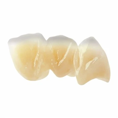 High Translucent Emax Bridge