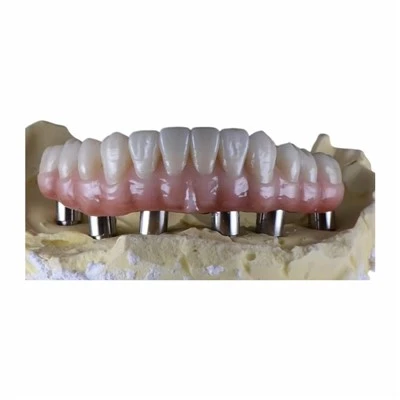 Hybrid Malo Bridge Screw Retained Implant Prosthesis