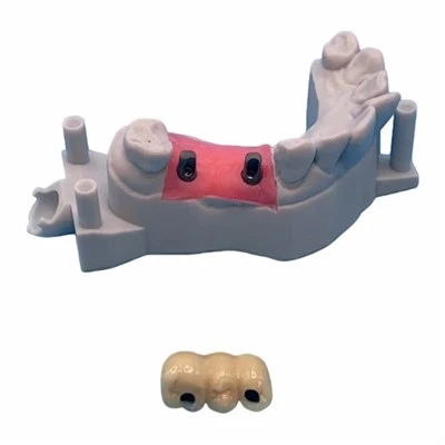 Implant Cocr PFM Bridge with Titanium Abutment