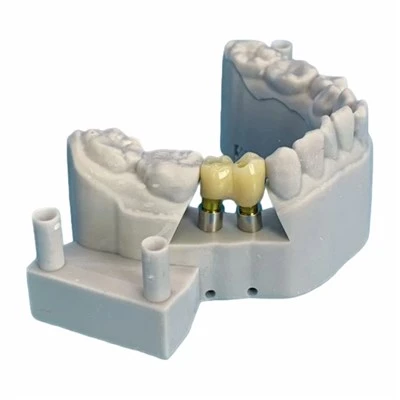 Implant Monolithic Zirconia Bridge