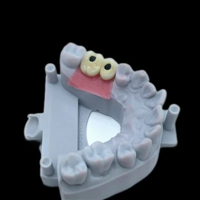 Implant PFM Bridge With Custom Titanium Abutment