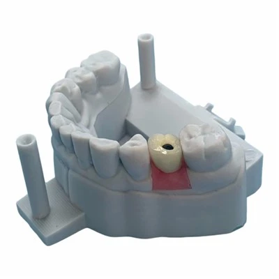 Implant PFM Crown with Titanium Abutment