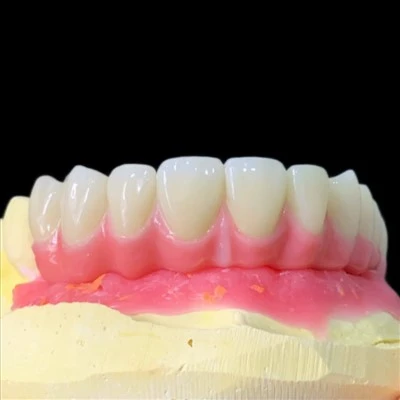 Implant Zirconia Malong Bridge