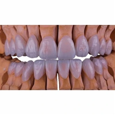IPS E.max Ceramic Veneer