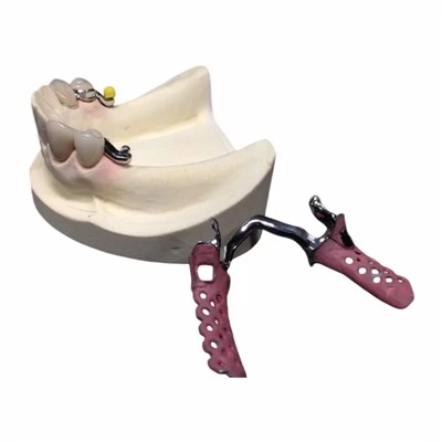 Keyway Precision Attachment Metal Framework Partial Denture