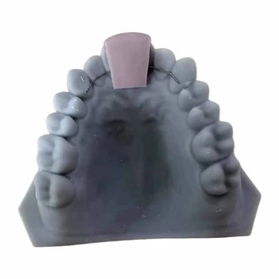Lingual Bonded Retainer