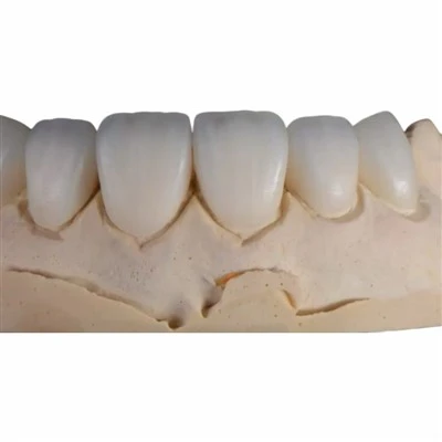 Lithium Disilicate Glass-Ceramic Veener