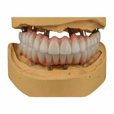 Malo Bridge Full Mouth Implant Restoration