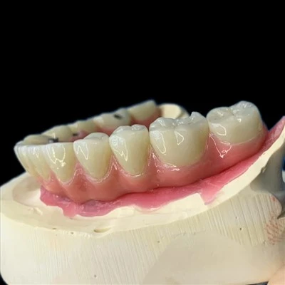 Malong Bridge – Full Arch Implant Hybrid Bridge