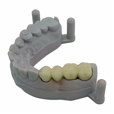Metal Ceramic Bridge