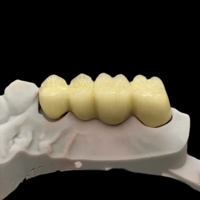 Metal Ceramic Posterior Bridge