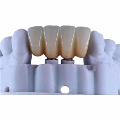 Personalized Titanium Abutment with Zirconia Bridge