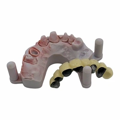 PFM Bridge with Metal Margin