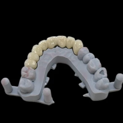 PFM Multi-Unit Bridge