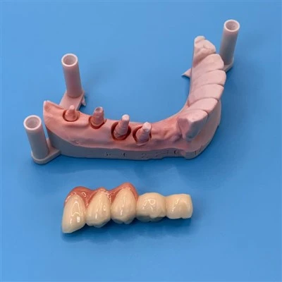 Porcelain Fused Metal Bridge With Gum Ceramic