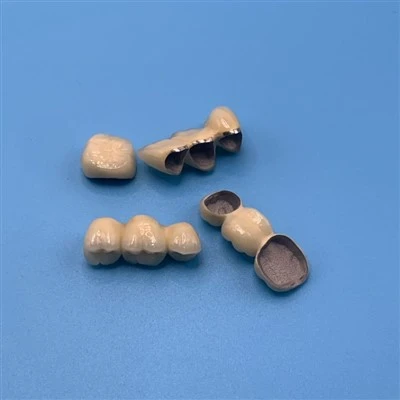 Porcelain Fused To Metal Bridge With Metal Margin
