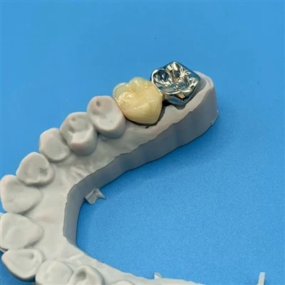 Posterior PFM Combine With Full Metal Crown