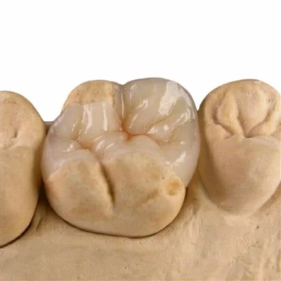 Premium E.max All-Ceramic Inlay