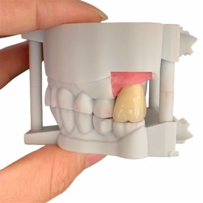 Pure Titanium Abutment with Cobalt Chromium Crown