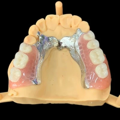 Removable Metal Framework With Acrylic Denture