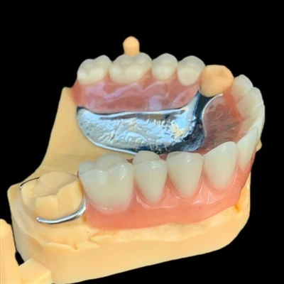 Removable Metal Framework With Denture