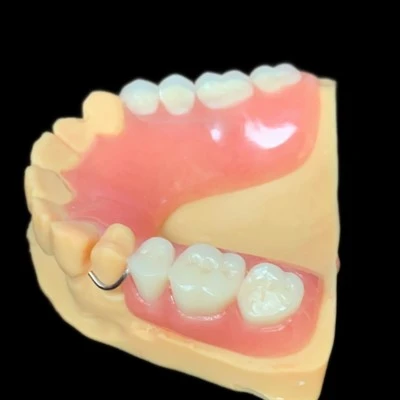 Removable Partial Denture With Wire Clasp