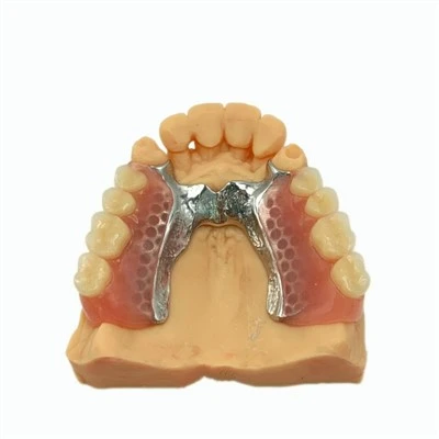 Removable Partial Metal Framework With Denture