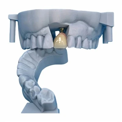 Screw-Retained Implant Full-Contour Zirconia Crown