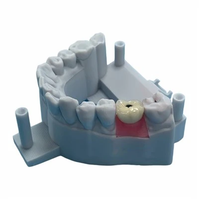 Screw-Retained Implant Metal Ceramic Crown
